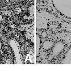 Photomicrographs Of The Initial Surgical Specimen Showing A A Typical