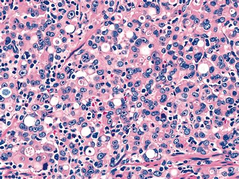 Pathology Outlines Adenocarcinoma Of Ge Junction