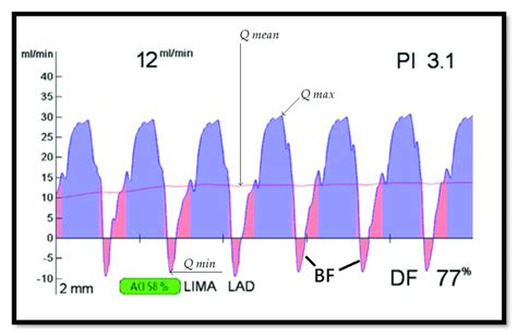 Graft flow assessment of the left internal mammary artery (LIMA) graft ...