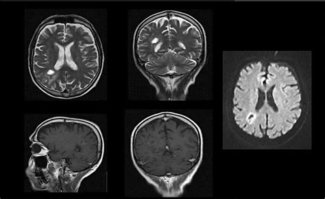 Figure From Brain Abscess Due To Staphylococcus Lugdunensis In The