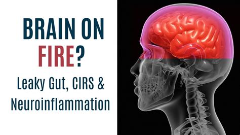 Is Your Brain On Fire Neuro Inflammation Leaky Gut And Cirs Youtube