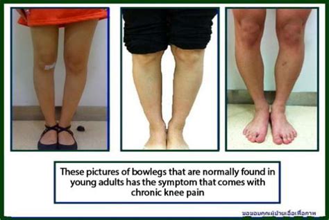 When do you need surgery for bowlegs? : Part 2 - Bangkok Advanced Clinics