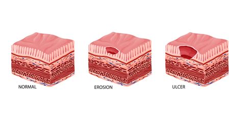 Peptic Ulcer Stages Development Illustration 22947140 Vector Art At