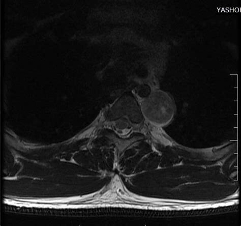 Robotic mediastinal tumor excision - Yashoda Hospitals