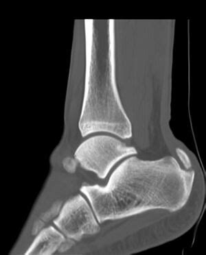 Figure Achilles Tendonitis Lateral Statpearls Ncbi Bookshelf Atelier