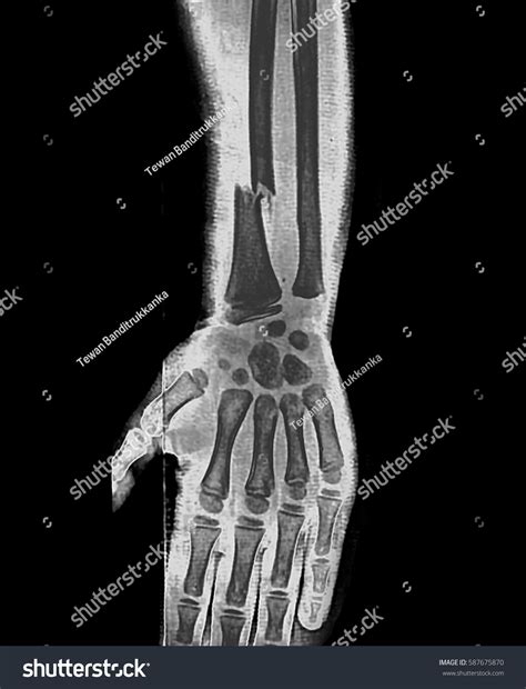 Xray Image Forearm Bone Fracture Radius Stock Photo 587675870