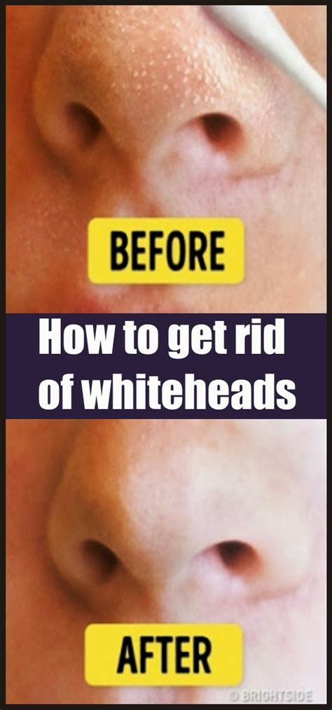 How To Get Rid Of Whiteheads Note In Beauty