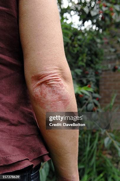 260 Psoriasis Arm Stock Photos High Res Pictures And Images Getty