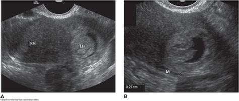 Chp Ectopic Pregnancy Flashcards Quizlet