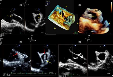 Multiplane 3D Transesophageal Echocardiography Monitoring To Improve