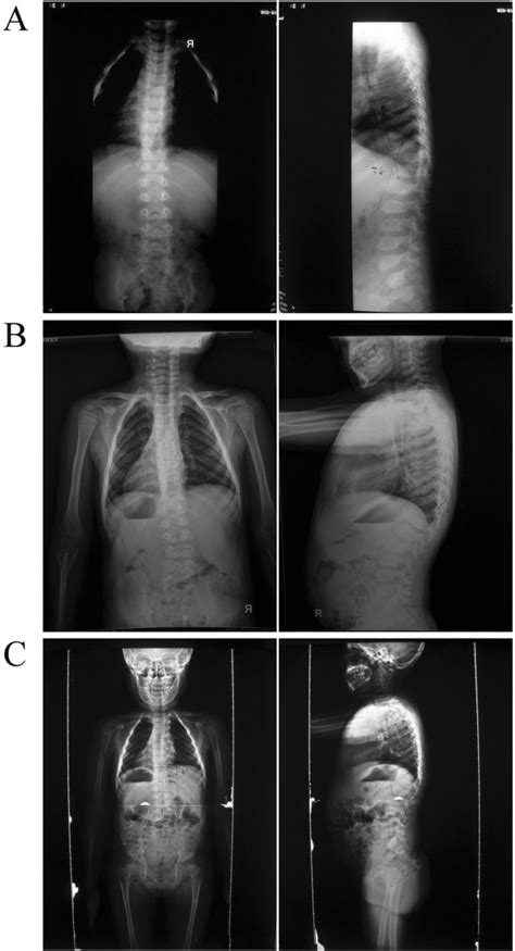 Preoperative Anteroposterior And Lateral Radiographs A Preoperative