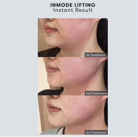 Inmode Treatment Sydney Evolution Laser Clinic Off