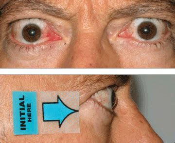 Thyroid Eye Disease Symptoms | TEPEZZA® (teprotumumab-trbw)