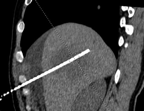 Multiple Electrode Radiofrequency Ablation Of Symptomatic Hepatic