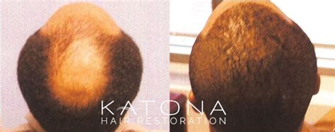 Dr Katona Hair Restoration Before And After Images