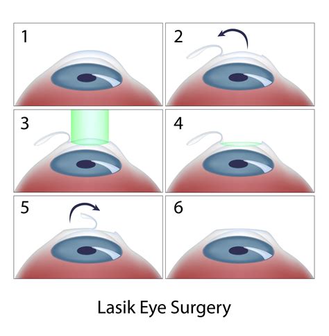 Laser Refractive Surgery: LASIK, LASEK, PRK and PTK - Discovery Eye ...