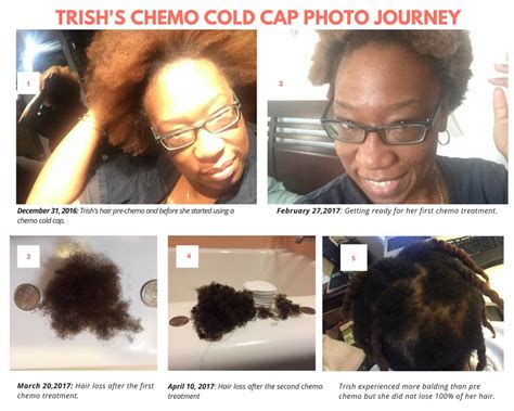 Do Chemo Cold Caps Really Work on Natural Hair? Trish's Chemo Hair Loss ...