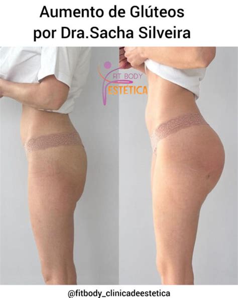 Aumento De Gl Teos Por Dra Sacha Silveira Cl Nica Fit Body Est Tica