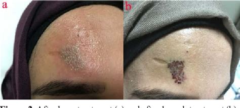 Figure 2 From Treatment Of The Nevus Of Ota With The 1064 Nm Q Switched