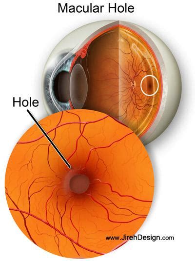 Macular hole - a patient's guide of causes and treatments