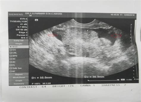 B Transvaginal Ultrasound Demonstrating 5 × 82 Cm Heterogenous Area Download Scientific