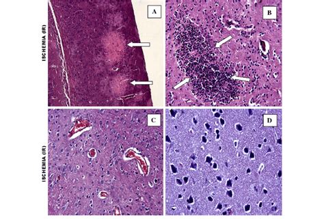 Focal Ischemia Areas Hande 910 Mononuclear Cell Infiltration Hande