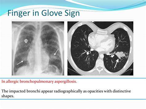 Ppt Radiological Signs Of Chest Disorders Part 1 Powerpoint