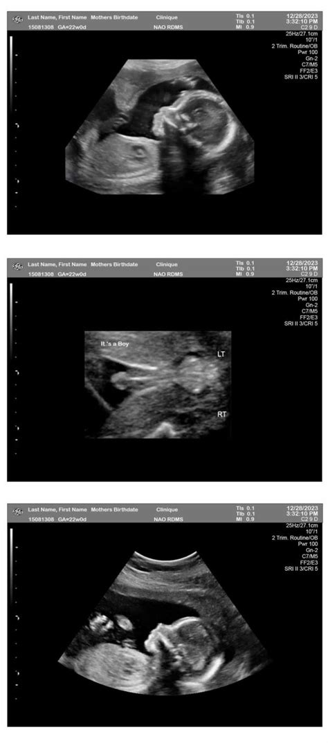 3-Fetuses 22 Weeks Ultrasound: Boy - Ultrasounds