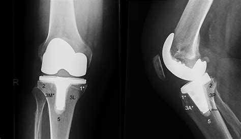 Aseptic Loosening At The Tibia In Total Knee Arthroplasty A Function Of Cement Mantle Quality