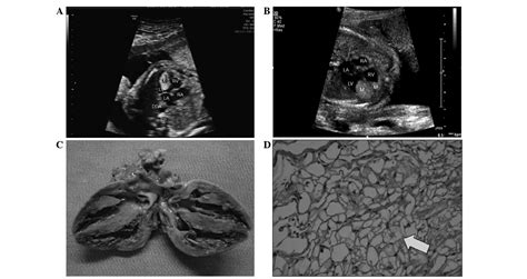 Clinical Value Of Prenatal Echocardiographic Examination In The