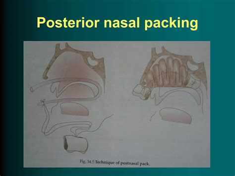 Epistaxis Ppt