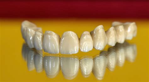 Puentes dentales de zirconio qué son y cuándo están indicados