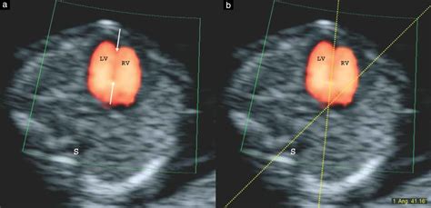 Defining The Fetal Cardiac Axis Between 11 0 And 14 6 Weeks Of