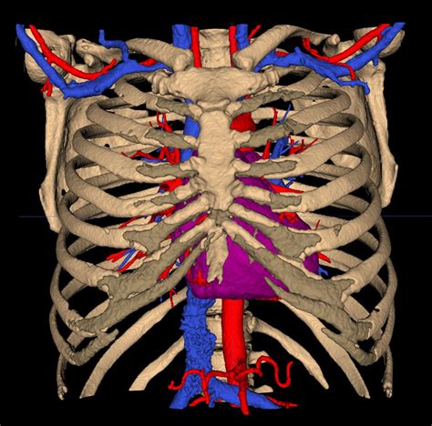 Artstation 3d Reconstruction Ct Scan 3d Printing