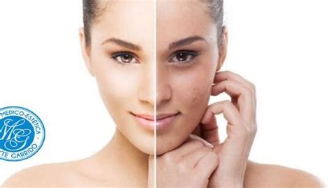 Eliminar Manchas Solares Del Rostro De Forma Natural