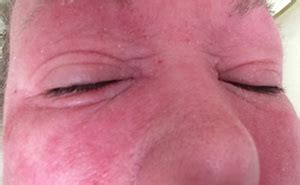 Red Skin Syndrome - Eczema Association of Australasia Inc