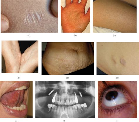 Figure 3 From Ehlers Danlos Syndrome Hypermobility Type An