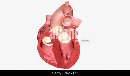 La Cardiomiopat A Es Una Enfermedad Del M Sculo Card Aco Que Hace Que