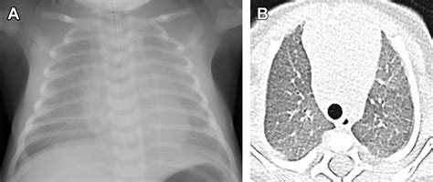 Respiratory Distress In Neonates Radiologic Clinics