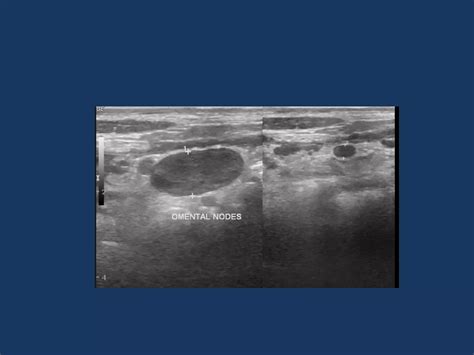 IMAGING IN ABDOMINAL TUBERCULOSIS | PPT