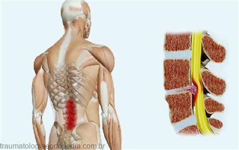 Descompressão Da Estenose Lombar Traumatologia E Ortopedia
