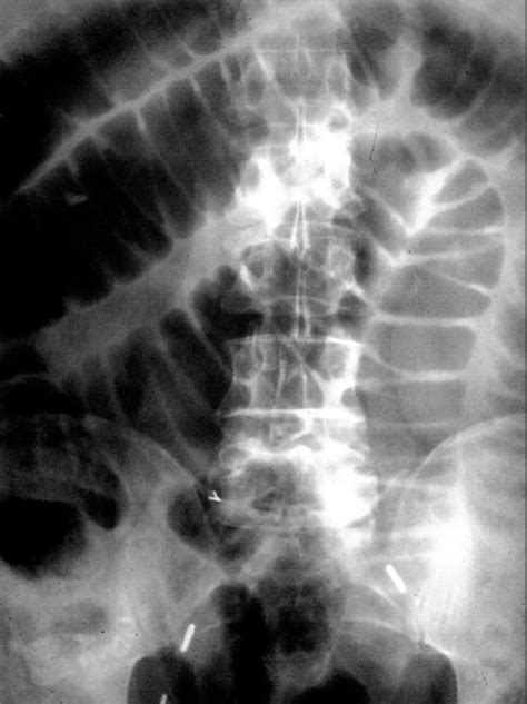 Plain Abdominal Radiograph Partial Small Bowel Obstruction