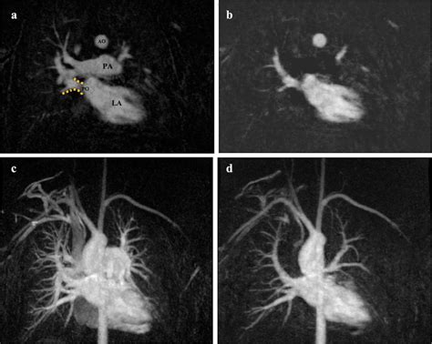 36 Year Old Male With TOF And Prior Corrective Surgery A Annotated