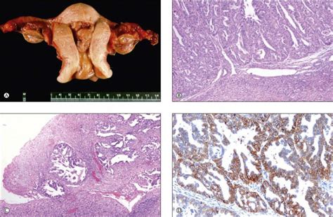 Ovarian Endometrioid Clear Cell Transitional And Mixed Epithelial