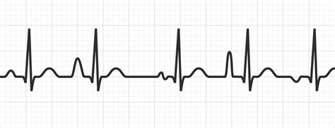 Multifocal Atrial Tachycardia / ECG Interpretation - MedSchool