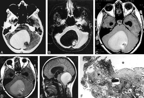 Unusual Imaging Appearance Of An Intracranial Dermoid Cyst American