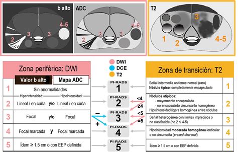 Resonancia Magnética De Próstata Guía Práctica De Interpretación E