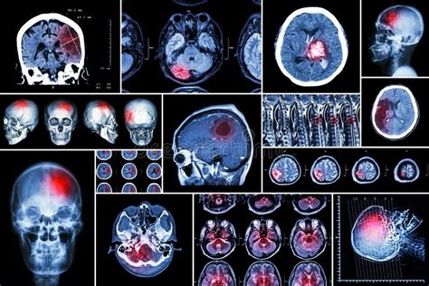 St Ll In Samlingen Av Hj Rnsjukdomen Cerebral Infarkt Den Hemorrhagic