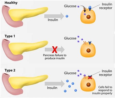 Diabetes Mellitus Types Symptoms And Preventions