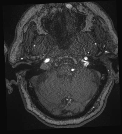 Dural Arteriovenous Fistula Radiology Reference Article Radiopaedia Org